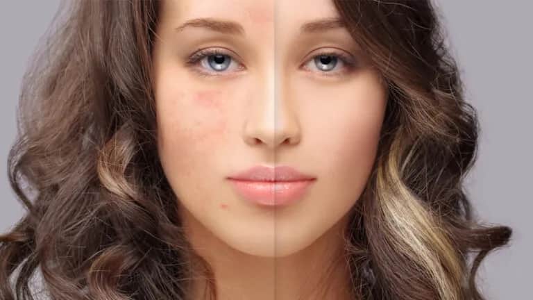 Jak skutecznie pozbyć się tłustej cery? 8 sprawdzonych metod