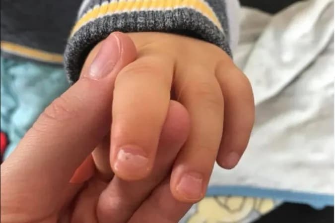 Co na schodzące paznokcie po bostonce? Skuteczne metody leczenia